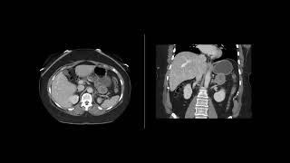 Gastrointestinal Stromal Tumor