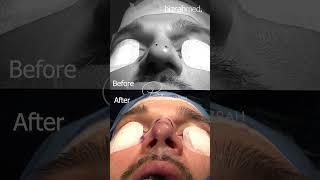 Nose Surgery Before & After | Nose Job Before and After by Dr. Bashar Bizrah, Dubai/London