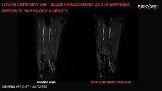 Lower extremity MRI_Medic Vision demo for short enhanced scan