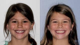 Phase I Braces with a Maxillary (Palatal) Expander Before and After