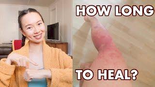 How Long to Heal Eczema