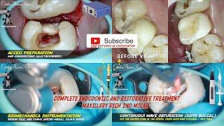 COMPLETE ENDODONTIC TREATMENT MOLAR TOOTH PERAWATAN SALURAN AKAR️NO RUBBER DAM NO ENDOCLINCAL CASE