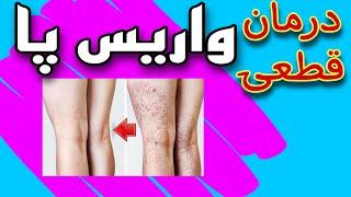 واریس پا | بیماری واریس پا رو جدی بگیرید | درمان قطعی واریس پا