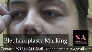 Blepharoplasty Marking | Dr. Shobhit Gupta