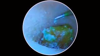 Tympanic membrane perforation and postoperative debridement for cholesteatoma #83