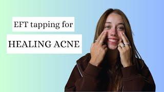 5 min EFT tapping for HEALING ACNE