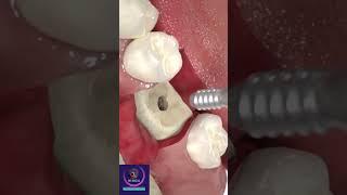 Dentistry - Implant surgery