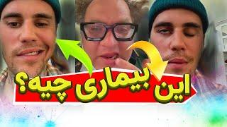 چرا نصف صورت جاستین بیبر فلج شد؟  ممکنه ما هم این بیماری رو بگیریم؟ | فلج شدن صورت مستر تیستر