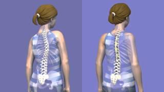 What is Scoliosis surgery?
