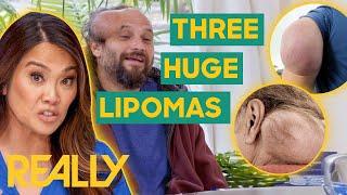 The Largest Lipoma Removals of Season 5 | Dr. Pimple Popper