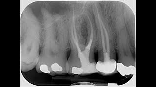 Maxillary molar access