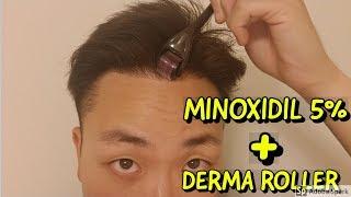 HOW TO USE DERMA ROLLER AND MINOXIDIL FOR HAIR GROWTH!