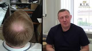 Пересадка волос в Real Trans Hair. Реальный опыт трансплантации. Отзыв Олега