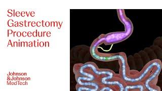 Sleeve Gastrectomy Procedure Animation | J&J MedTech