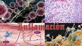 Inflamación aguda y crónica