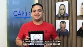 TESTIMONIO INJERTO CAPILAR