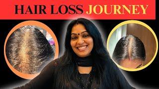 My Hair Loss Journey | എന്റെ മുടി കൊഴിച്ചിൽ എങ്ങനെ കുറച്ചു ? | മാനസിക വേദനയും ഡിപ്രെഷനും|   Part 1