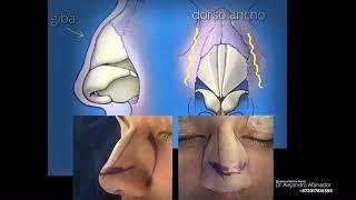 Tabique Nasal Correción de giba