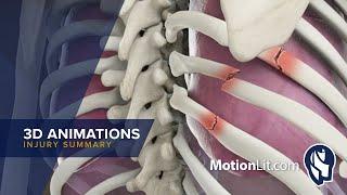 3D Animation Depicts Pneumothorax Injury In Police Abuse Case