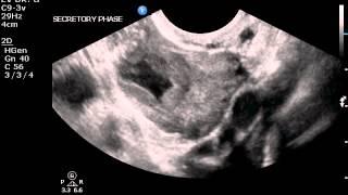 Transvaginal ultrasound of corpus luteum cyst (no color)