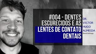 Lente de contato dental para dente preto. | Dr. Victor Hugo Almeida