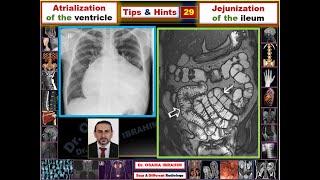 Tips & Hints 29 Jejunization of the ileum/ Atrialization of the ventricle