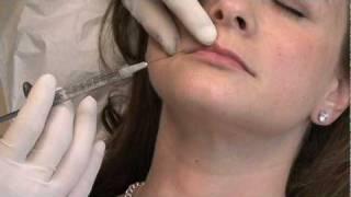 Lip Augmentation by Dr. Phillip Chang at Aesthetica