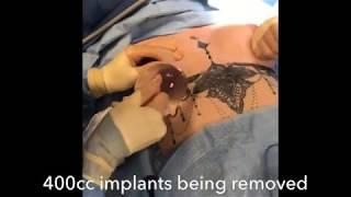 Implant Exchange: How a Implant Exchange Is Done