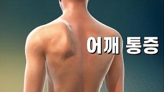 익상견갑 교정. 전거근 운동. 어깨 통증 완화