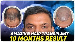 Hair Transplant in Pakistan | Best Results & Cost of Hair Transplant in Pakistan