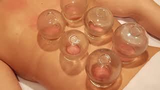 Chinese Cupping Therapy   jav sub