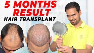 Hair Transplant in Gorakhpur | Best Results & Cost of Hair Transplant in Gorakhpur