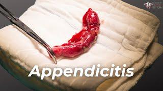 What Causes Appendicitis & How to Treat It