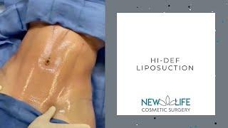 Hi-Def Liposuction | Cosmetic Surgeon | Mcallen, Texas