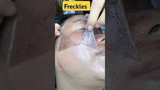 Freckles Kyun hota hai or Kaise kam kare? | Best Treatment for Freckles | Skin Specialist in Delhi