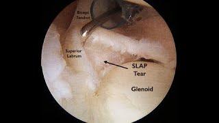 Superior Labrum Anterior to Posterior Tears and Lesions of the Proximal Biceps Tendon.