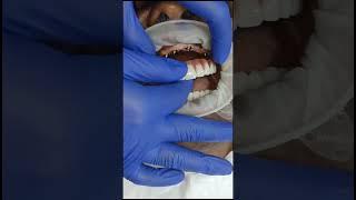 Beautiful screw retained full mouth prosthesis implants in 5days in best laser dental clinic Chennai