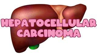 Hepatocellular Carcinoma | Liver pathology