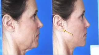 How can you hide the face lift incisions - By Dr. Kridel