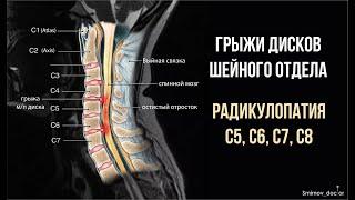 Грыжа шейного отдела позвоночника  Радикулопатия С5, С6, С7, С8  Тест Спурлинга