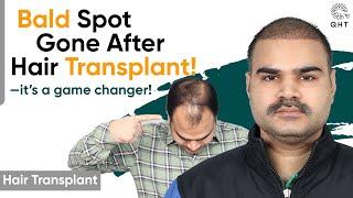 Hair Transplant in Nagpur | Best Results & Cost of Hair Transplant in Nagpur