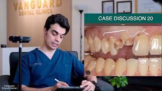 Badly broken teeth fixed! - Case Discussion 20