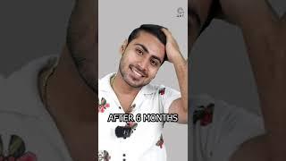 Six Months Hair Transplant Results | Latest Fue Technique #shorts #viral #hair transplant