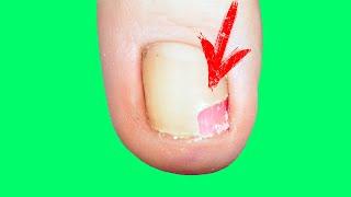 Cleansing Onycholysis | emptiness under toenails | Part 2