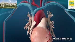 Coronary Artery Angioplasty Radial Access - CIMS Hospital