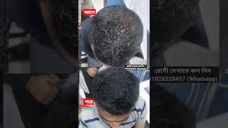 বংশগত চুল পড়া বন্ধ হবেই । চুল পড়া কমানোর উপায়। How to reduce hairfall? Dr Mahamudul Islam Chowdhury