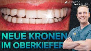 Kronenerneuerung - Vollkeramik im Oberkiefer | Freshup einer Patientin