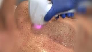 Il nuovo LASER DIODO di EPILASER PROFESSIONALE.IT