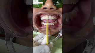 Best Dental Crown | Zirconia | Best Dentist in Kolkata - #zirconiacrown #smilemakeover #smiledesign