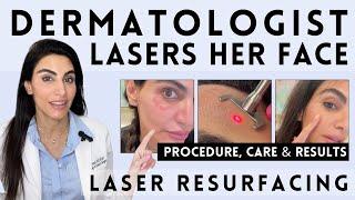 What it’s Like to Have Laser Resurfacing: Procedure, Care & Results | Dermatologist Tests